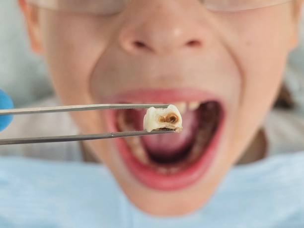 Best Emergency Wisdom Tooth Extraction in Lake Don Pedro, CA